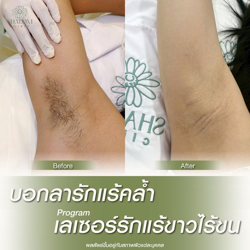 Underarm Whitening